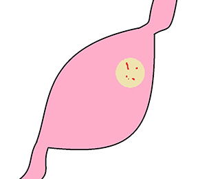 胃のイラスト
